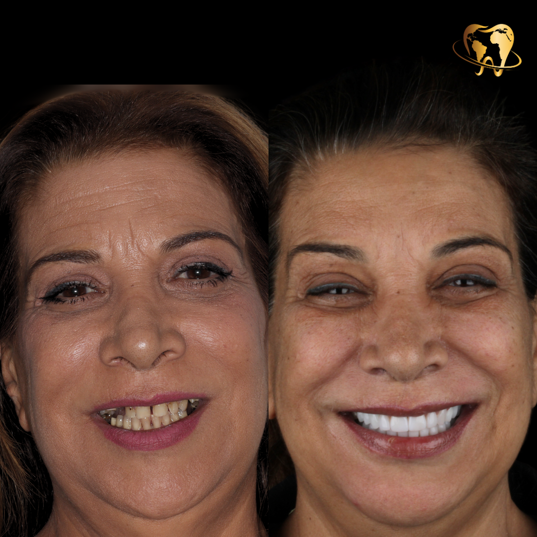 ANTES-Y-DESPUES-DENTAL-EXPERIENCE