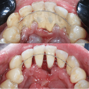 PERIODONCIA